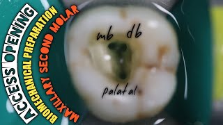 Access Opening in Maxillary Second Molar Biomechanical Preparation  Protaper Rotary Endodontics [upl. by Sudoeht692]