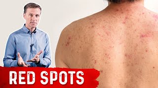 Why Red Spots on My Skin – DrBerg on Skin Red Spots Causes amp Remedies [upl. by Orfinger]