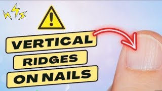 what causes vertical ridges on nailsthat is the real cause of vertical ridges on your nailsreels [upl. by Desirea610]