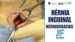 HÉRNIAS ABDOMINAIS Parte 8 INGUINAL E FEMORAL HERNIORRAFIAS 👨🏽‍⚕️🚑 Joao Fonseca Cir Geral [upl. by Emya]