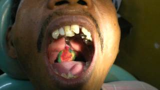 Dr Pankaj Kharade Pharyngeal obturator impression [upl. by Kipp]