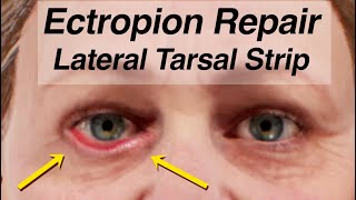 Ectropion Repair Using a Lateral Tarsal Strip Lower Eyelid Drooping After Facial Paralysis [upl. by Cassandre]