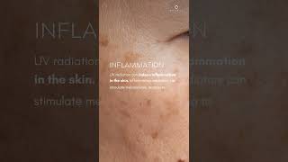 Why does UV radiation cause pigmentation  Ensoul Medical Clinic [upl. by Ailed407]