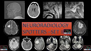 NEURORADIOLOGY SPOTTERS SET II [upl. by Meesak54]