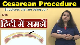 Cesarean Delivery in Hindi  Preoperative Care Procedure Postoperative care  Nursing Lecture [upl. by Latashia]