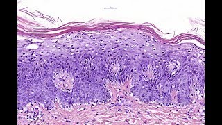 Acrodermatitis enteropathica Phillip H McKee Antonina Kalmykova  CSD Health Care [upl. by Sharia855]