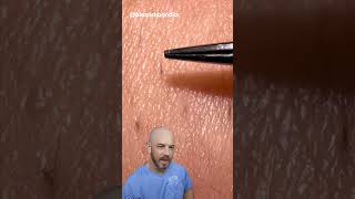 These ingrown hair pulls are super satisfying credit blemishbandits on TT doctor satisfying [upl. by Senaj]