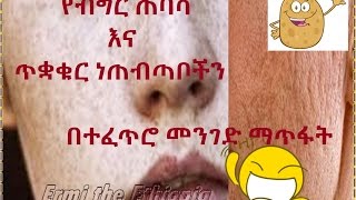 Ethiopian  በተፈጥሮ መንገድ ጥቋቁር ነጠብጣቦችን እና የብግር ጠባሳዎችን ያጥፊያ dark spot acne scar treatment [upl. by Guillaume635]