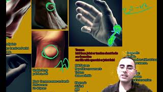 Lump on the wrist  Ganglion cyst symptoms causes treatment prognosis [upl. by Pfister]