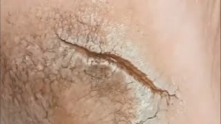 Pedicure video35，A large tear in the heel，vertical plantaris，plantar wart [upl. by Pearline374]