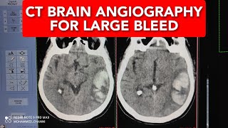 BRAIN HEMORRHAGE  CT SCAN ANGIOGRAPHY [upl. by Garap]