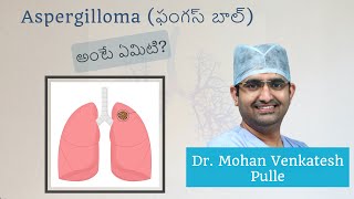 What is Aspergilloma Fungus Ball  By Dr Mohan Venkatesh Pulle  in Telugu [upl. by Ylloj]