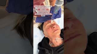 Microneedling Treatment by Jen the Esty [upl. by Karmen]