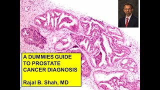 A Dummies Guide to Prostate Cancer Diagnosis [upl. by Queen]