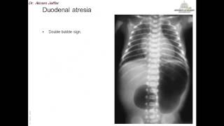 Embryology of Congenital Anomalies of the Foregut 2 [upl. by Los259]