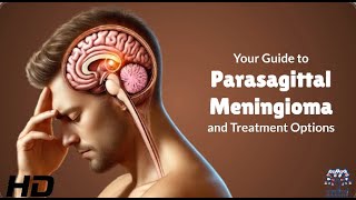 What Is Parasagittal Meningioma A Doctor’s Insight [upl. by Meikah541]