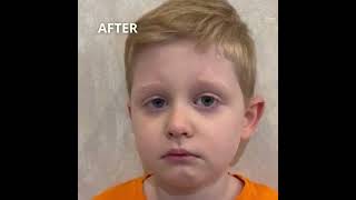 NYSTAGMUS TREATMENT SUCCESSFUL CASE CRYSTAL VISION CLINIC [upl. by Airlee]