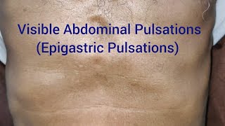 Clinical Examination Visible Epigastric Pulsations [upl. by Flavius817]