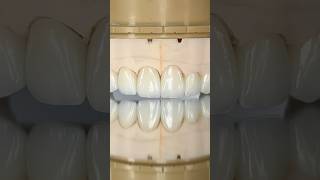 Maxillary Zen Enamel Zirconia Crowns ​⁠EnvisiontecMain envisiontec lsk121shorts dentist [upl. by Alie]