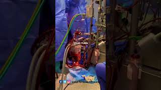 Perfusion aspects by a clinical Perfusionist perfusion nurse [upl. by Lennie]