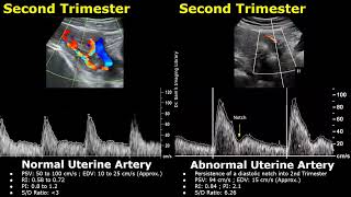 Uterine Artery Spectral Doppler Ultrasound Normal Vs Abnormal Images  PregnantNongravid Uterus USG [upl. by Hyrup702]