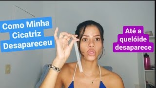 Como Minha Cicatriz De Silicone DesapareceuAdeus quelóide Lifesil vs Drenison [upl. by Elletnahc]