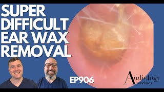 SUPER DIFFICULT EAR WAX REMOVAL  EP906 [upl. by Aubine]