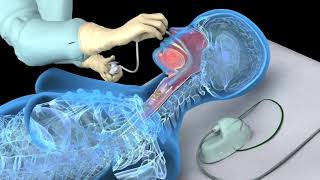 Nasotracheal suctioning NTS  3D animation [upl. by Leesa858]