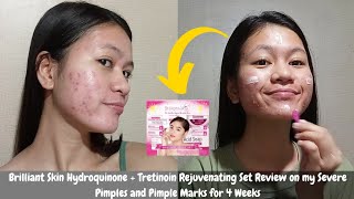 I tried Brilliant Skin Hydroquinone  Tretinoin Rejuvenating Set on my Severe Pimples amp Pimple Marks [upl. by Mateya]