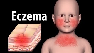 Eczema Animation [upl. by Uzial339]