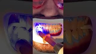 Teeth whitening process [upl. by Cammy]