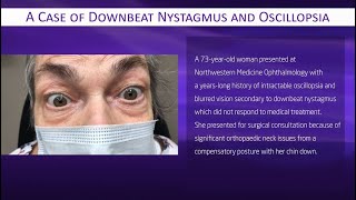 A Case of Downbeat Nystagmus and Oscillopsia [upl. by Yllus]