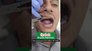 QUICK Braces Removal in 10 minutes Dr Srishti Bhatia braces cosmeticdentistry [upl. by Eerrehs]