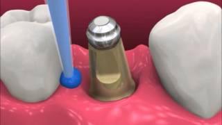 Smyl Manatee  Dental Implant Procedure [upl. by Theresita]