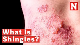 What Is Shingles [upl. by Ahselet]