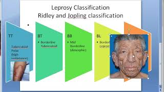 Pathology 160 a Leprosy Classification Difference Tuberculoid Lepromatous Ridley jopling TT BT BB LL [upl. by Aical975]