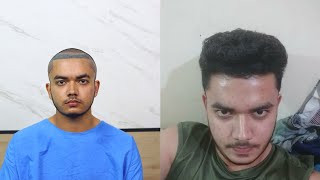 2nd PRP After Hair Transplant  PRP Treatment Bhopal  Stop Hairfall  teenage [upl. by Ayian115]