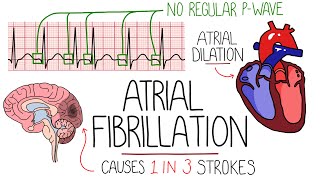 Atrial Fibrillation Made Easy Complete Overview [upl. by Nyrek]