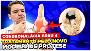 NOVA PRÓTESE DA PATELA PODE SER UMA SOLUÇÃO  Condromalácia [upl. by Yaffit]