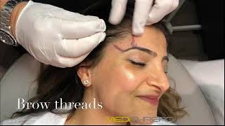 PDOTHREAD LIFT PROCEDURE BY MEDiTHREAD  Eyebrow Lift [upl. by Anreval974]