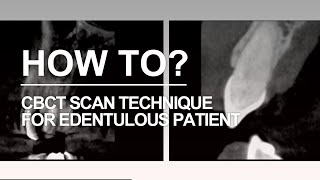 Edentulous case CBCT DIOnavi Learning Contents [upl. by Antony]