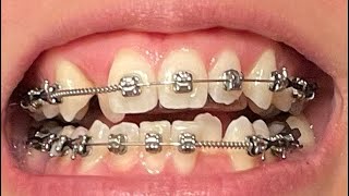 Adult Braces Time Lapse  8 Month Progression  Front View  Premolar Extraction  Moving Canine [upl. by Limoli]