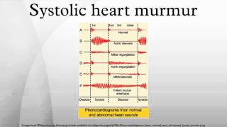 Systolic heart murmur [upl. by Iolenta]