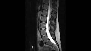 Lumbar spine disc herniations [upl. by Hooke]