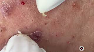 Big Cystic Acne Blackheads Extraction Blackheads amp Milia Whiteheads Removal Pimple Popping [upl. by Yelsehc]