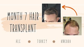 Loving It Month 7 Hair Transplant HLC clinic Turkey [upl. by Ynamad107]