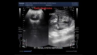 Renal Cystic Nephroma [upl. by Brackely]