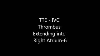 IVC Thrombus Extending into Right Atrium  Transthoracic Echocardiogram TTE [upl. by Nahtnamas]