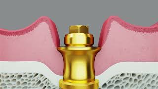 Meet the new Multiunit Abutment for Conical Connection [upl. by Eikcin]