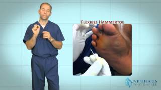 New Hammertoe Correction Procedure Performed in the Office [upl. by Sterne]